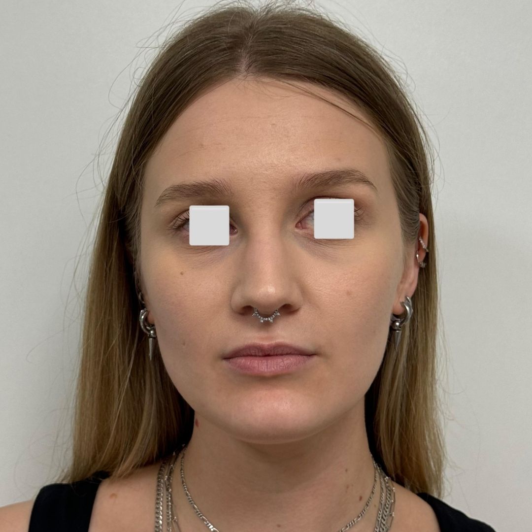 Labios con Acido hialuronico antes 1