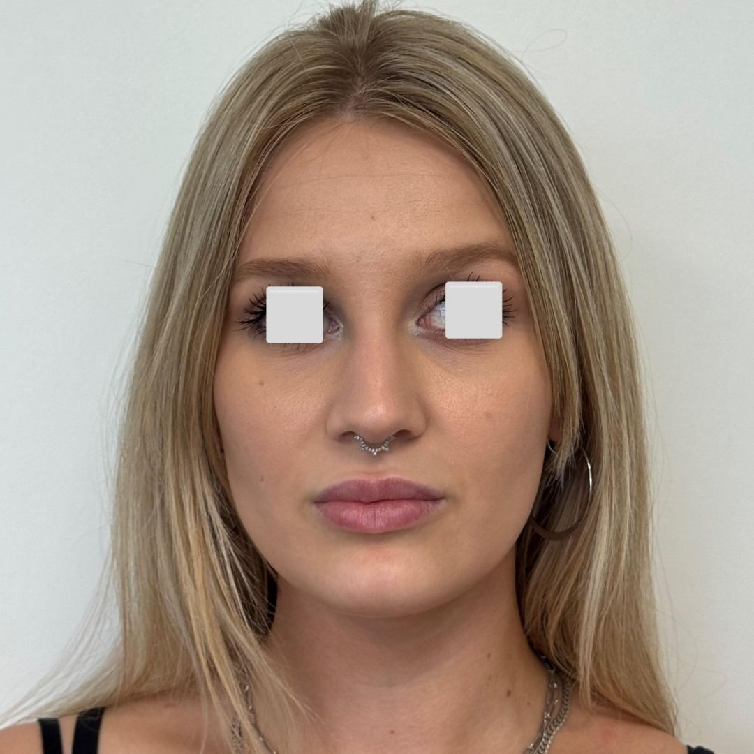 Labios con Acido hialuronico después 1